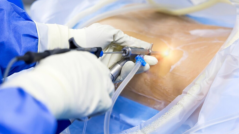 Tam kapalı bel fıtığı ameliyatı iyileşme süresini hızlandırıyor